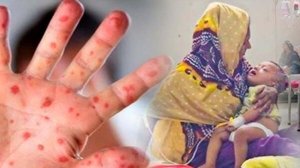 হামের উপসর্গ নিয়ে দেশে আরও ১১ শিশুর মৃত্যু